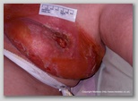 malignant cancerous wound